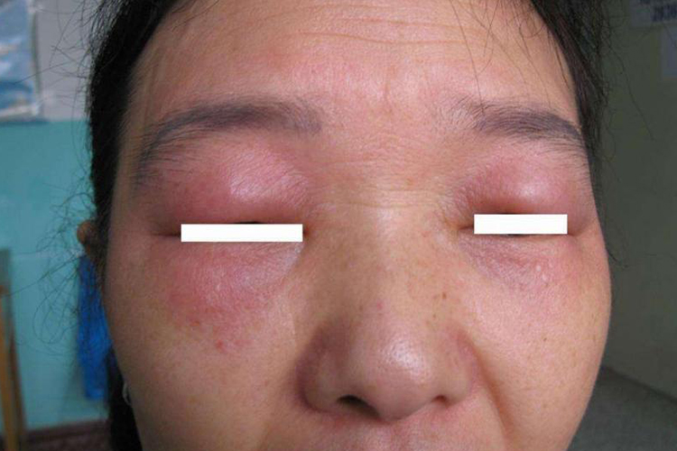 茯苓过敏眼周血管神经性水肿图