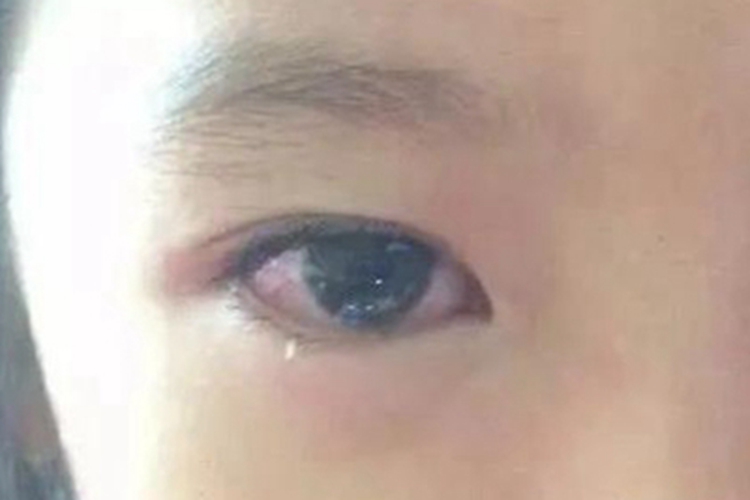 川崎病白眼球部分发红图 川崎病白眼球部分发红图