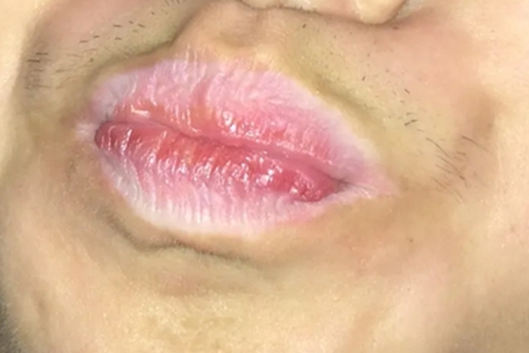 利什曼病嘴唇发白图