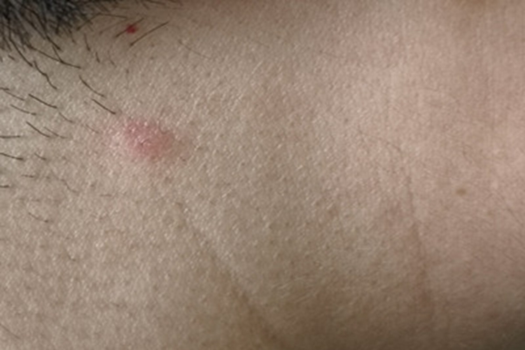 玫瑰糠疹侧颈红斑图 玫瑰糠疹侧颈红斑图