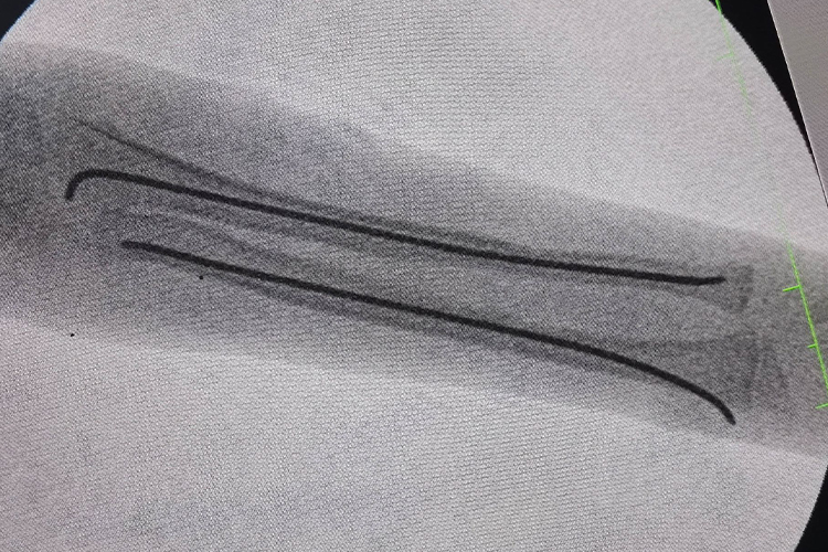 骨折髓内针影像图