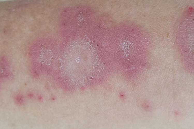 亚急性湿疹红斑图