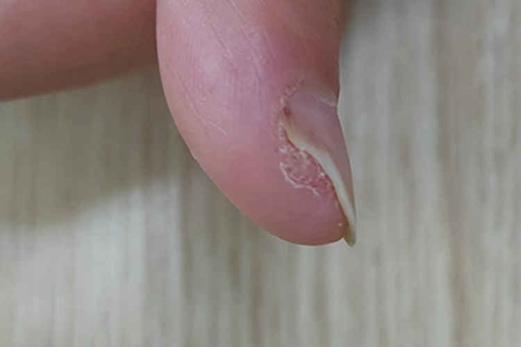 寻常疣手指甲上翘图 寻常疣手指甲上翘图