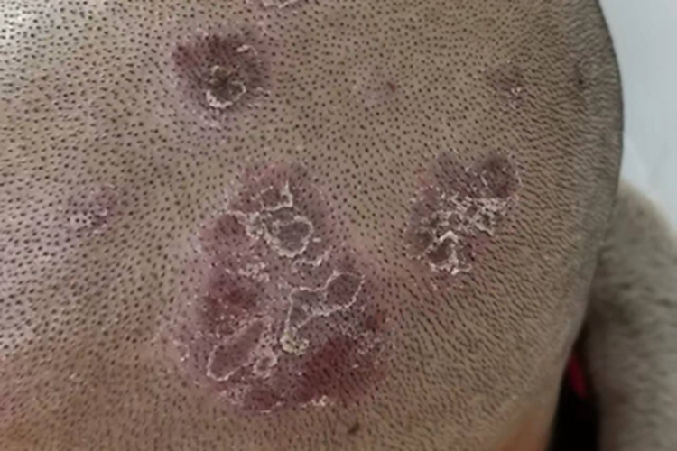 慢性湿疹症状图片