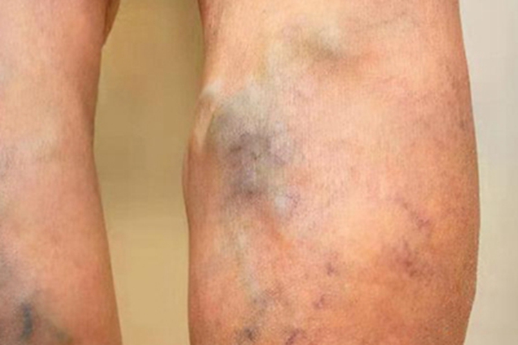 下肢深静脉血栓形成静脉曲张图 下肢深静脉血栓形成静脉曲张图