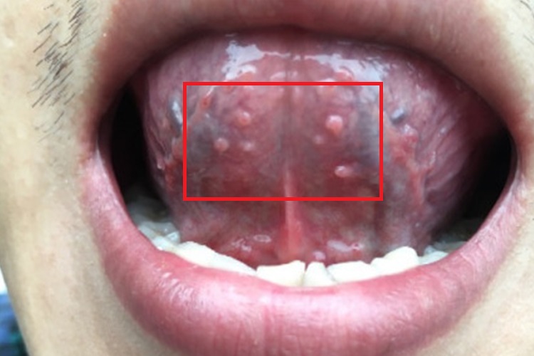 舌下尖锐湿疣图 舌下尖锐湿疣图