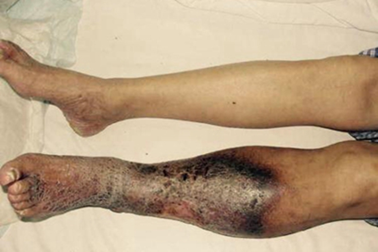 原发性大隐静脉曲张左腿发黑图