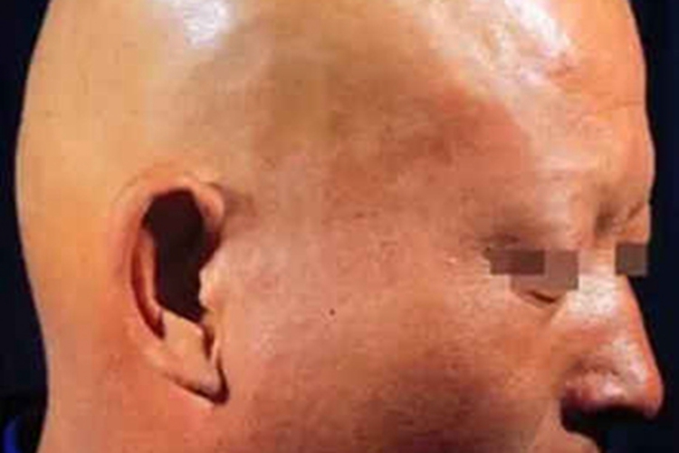 油风脱发头发全掉了图