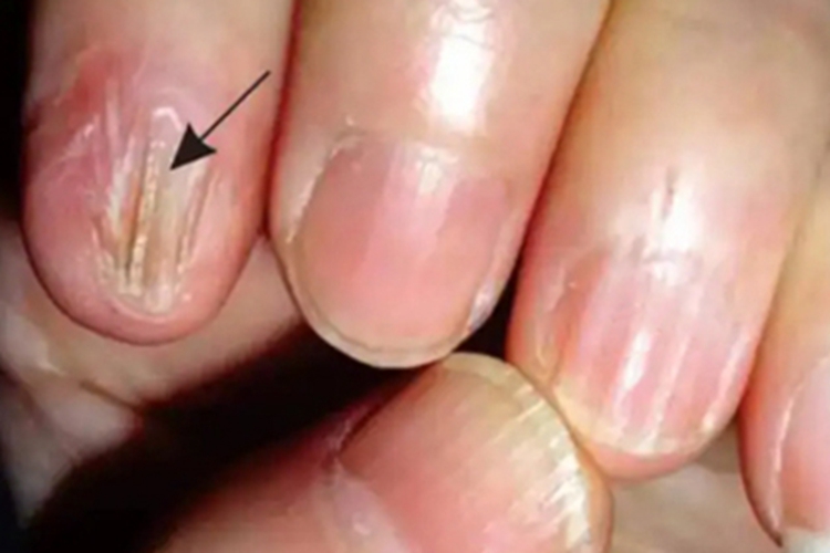 甲萎缩手指甲竖纹症状图