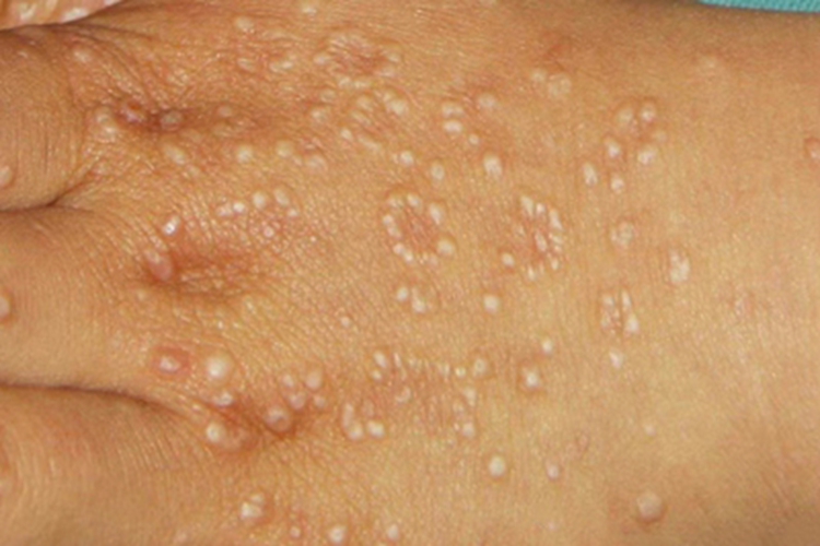 泛发型环状肉芽肿手背小疙瘩图