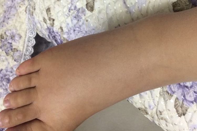 脚摔伤肿胀图 脚摔伤肿胀图