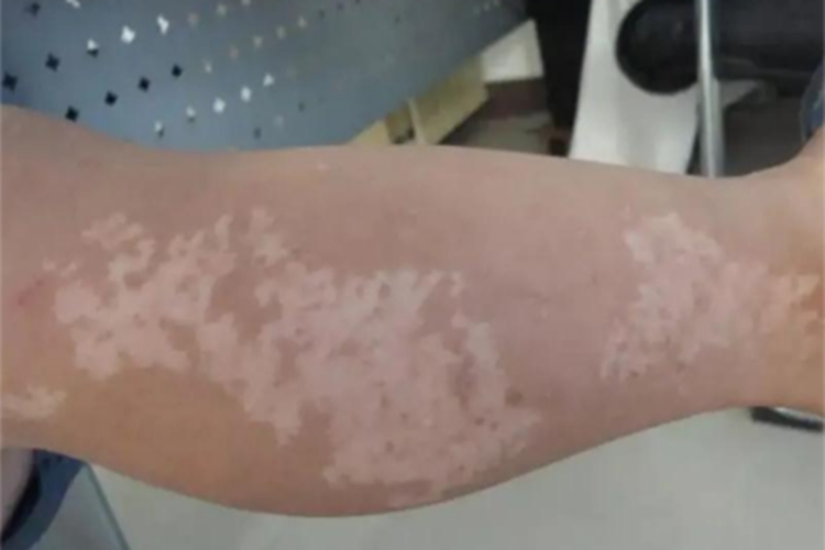 稳定期节段型白癜风小腿症状图