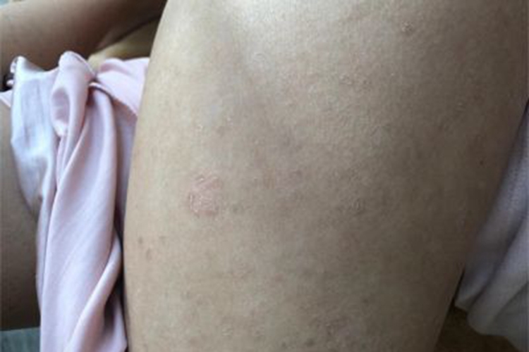 慢性苔藓样糠疹大腿脱皮图 慢性苔藓样糠疹大腿脱皮图