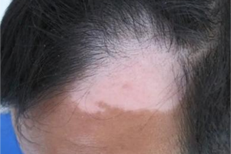 稳定期节段型白癜风白斑图 稳定期节段型白癜风白斑图