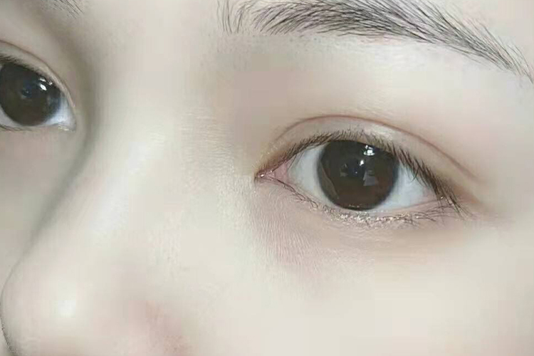 重睑成形术半年恢复图