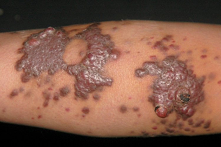 艾滋病结节图