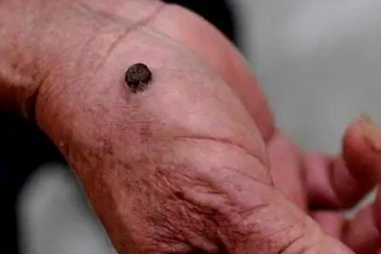 皮肤基底细胞癌手部黑疙瘩图