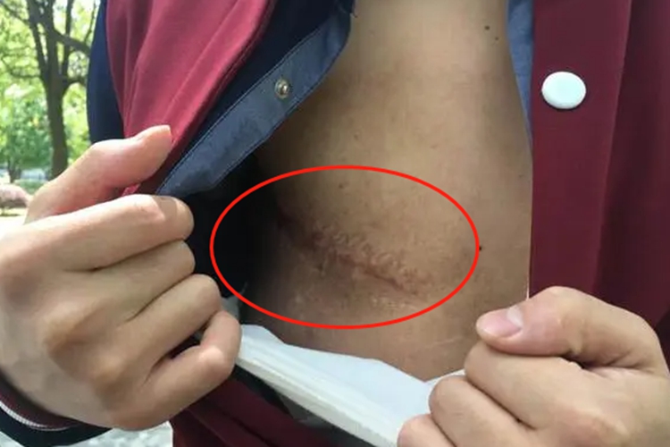 男性乳腺切除后的样子