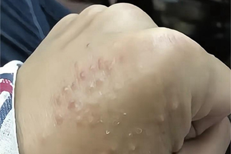 慢性接触性皮炎手背小疙瘩图