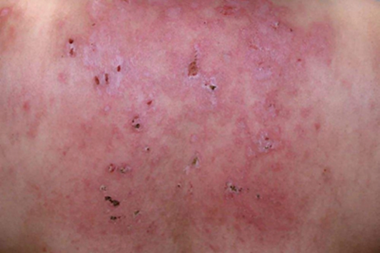 血管萎缩性皮肤异色病背部结痂图