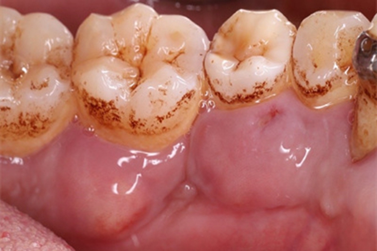 急性牙周脓肿牙龈肿大起包图