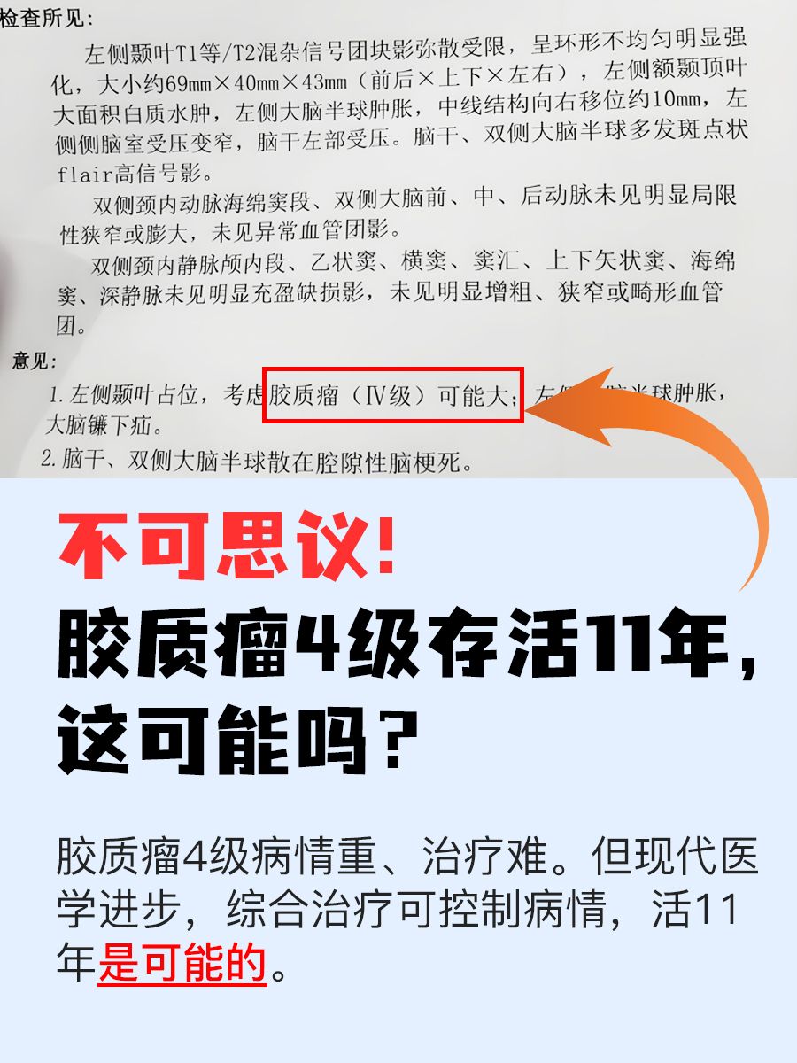 不可思议!胶质瘤4级存活11年,这可能吗?