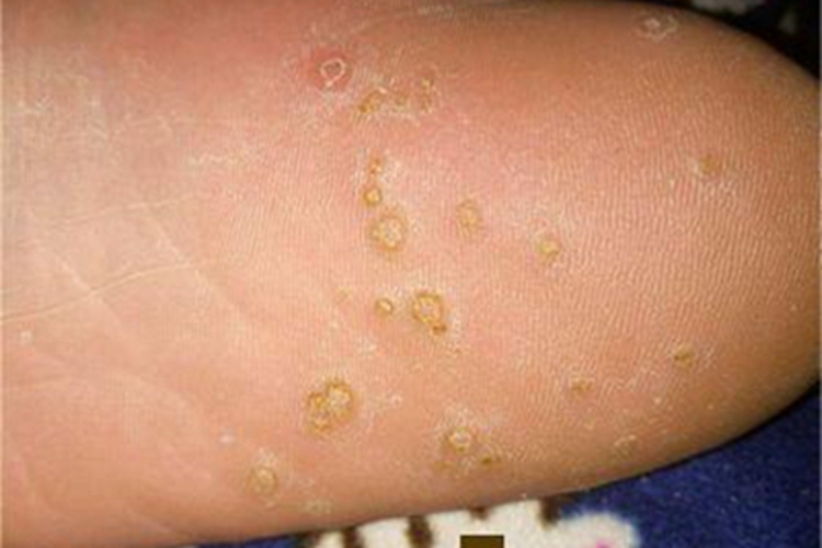 边缘丘疹性肢端角皮病脚底症状图