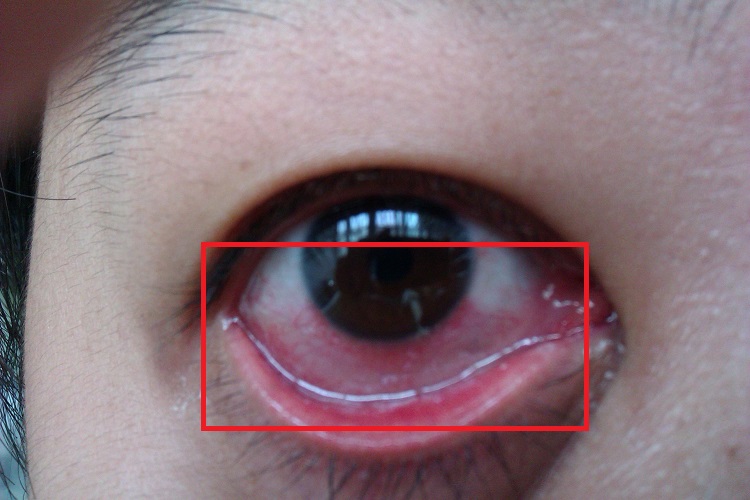 结膜炎结膜混浊图