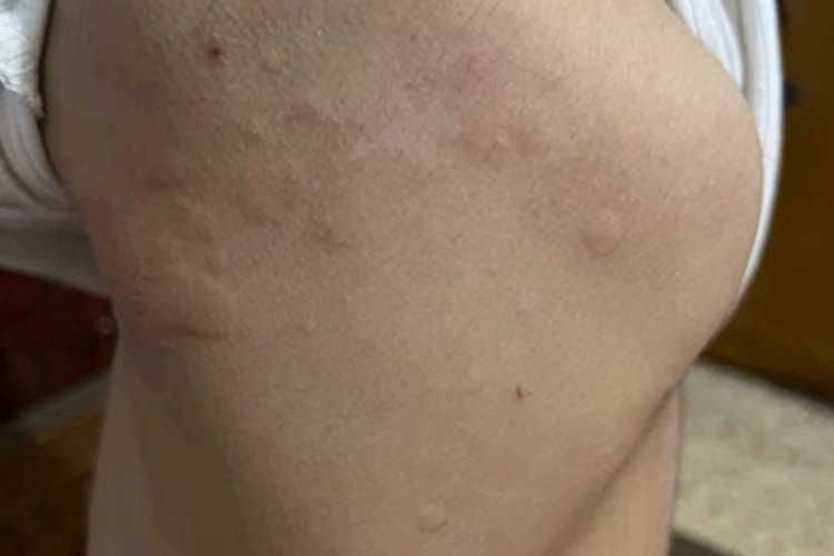 急性自发性荨麻疹腿风团图 急性自发性荨麻疹腿风团图