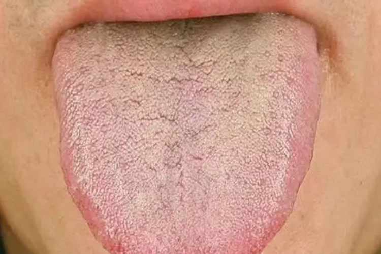 胃热炽盛舌苔图