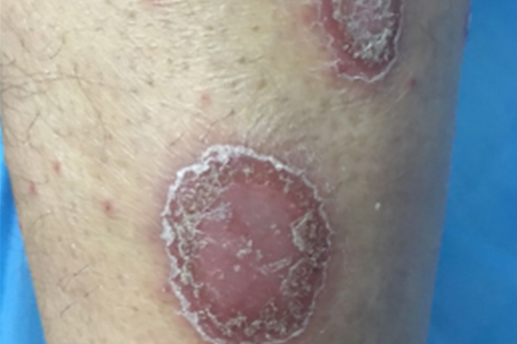 钱币状银屑病图