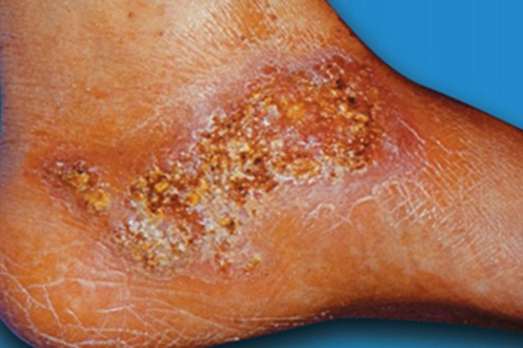 足菌肿脚部结痂图