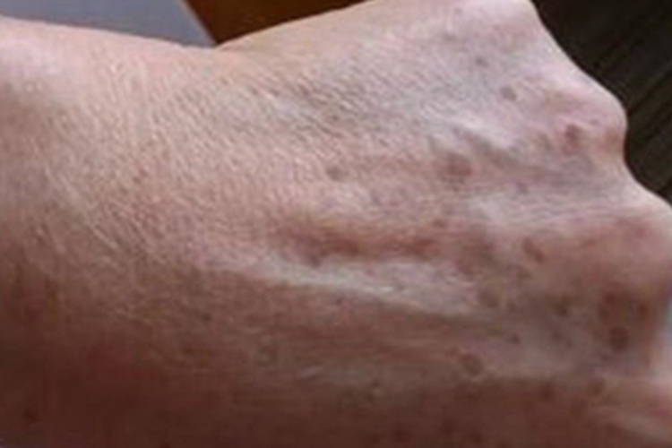 职业性疣赘手背斑图 职业性疣赘手背斑图