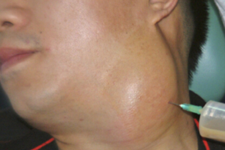 腮裂囊肿侧颈肿块图