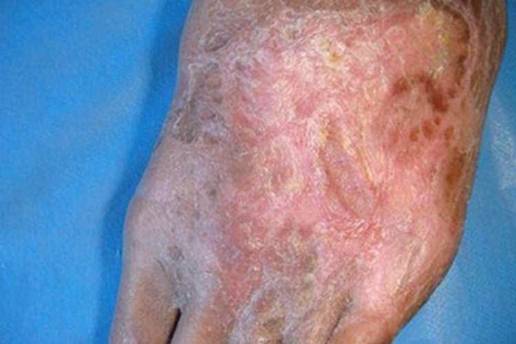 血栓闭塞性脉管炎瘢痕图 血栓闭塞性脉管炎瘢痕图