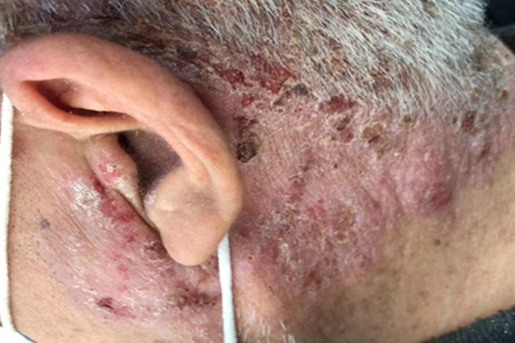 慢性湿疹耳后症状图