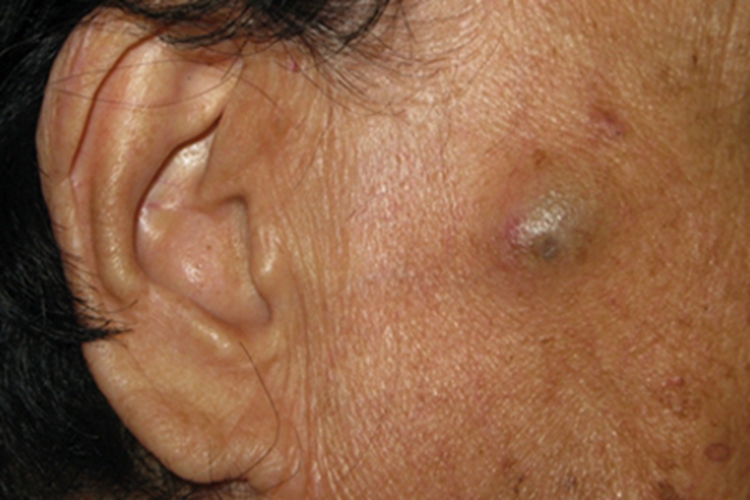 皮样囊肿面部有小结节图 皮样囊肿面部有小结节图