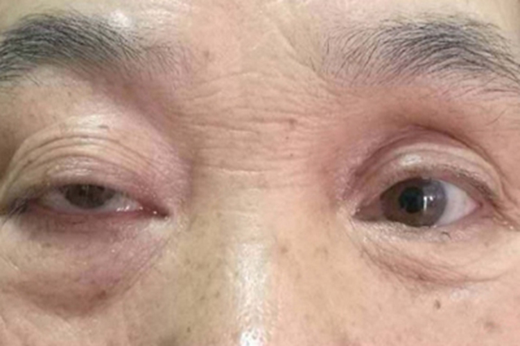 眼眶淋巴瘤眼睑下垂图 眼眶淋巴瘤眼睑下垂图