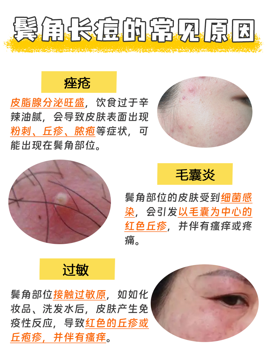 鬓角长痘的幕后黑手,你知道吗?