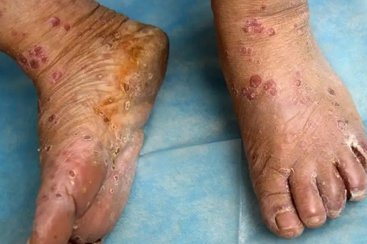 脚部梅毒疹图 脚部梅毒疹图