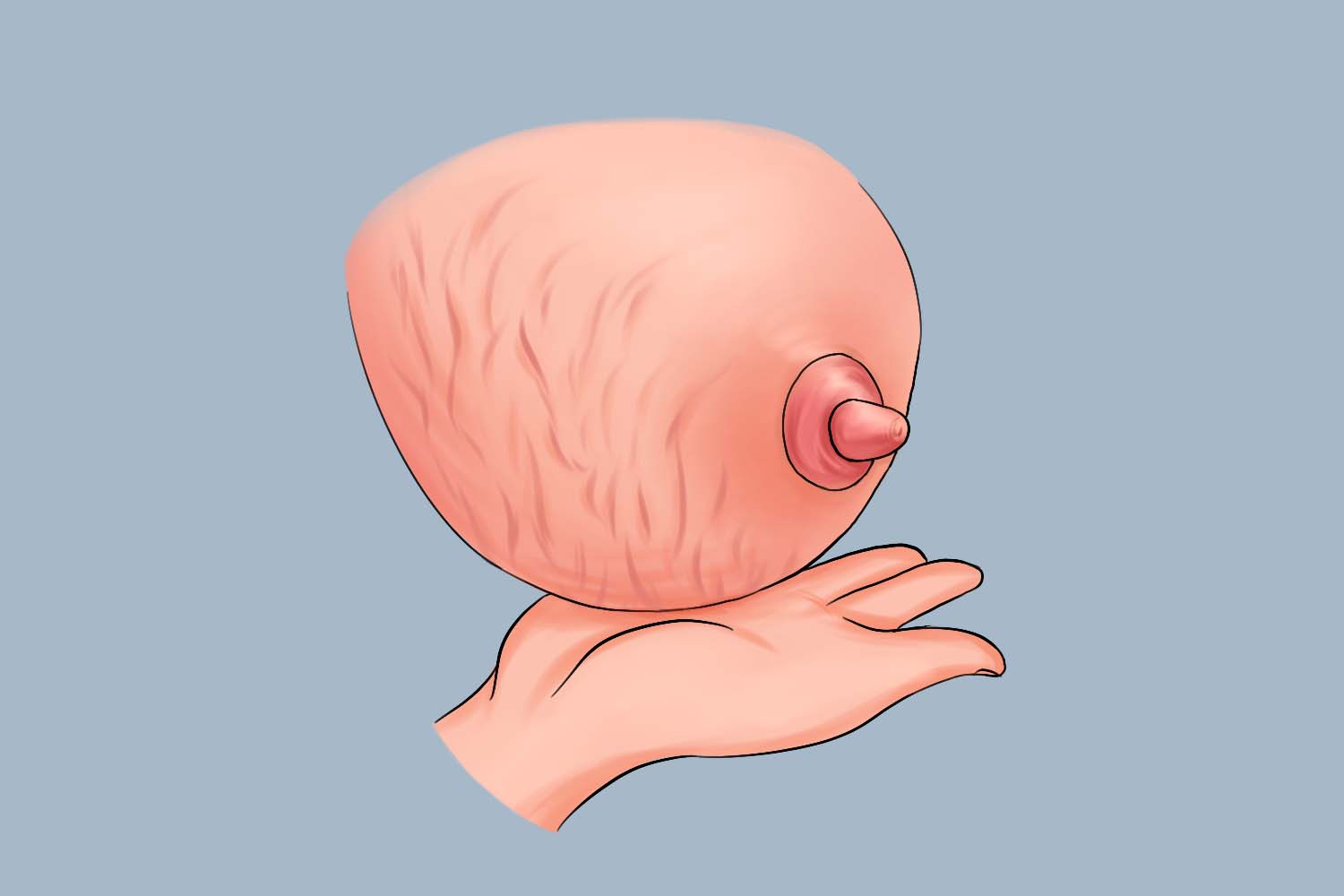 乳房红色条纹状图