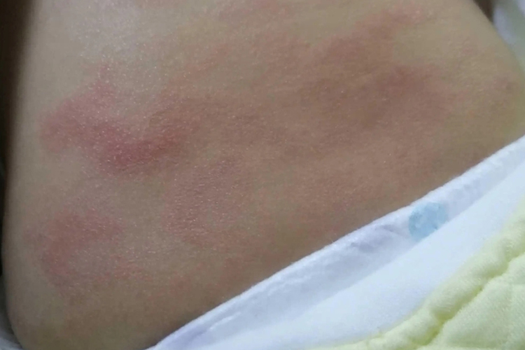 儿童大腿内侧特应性皮炎图