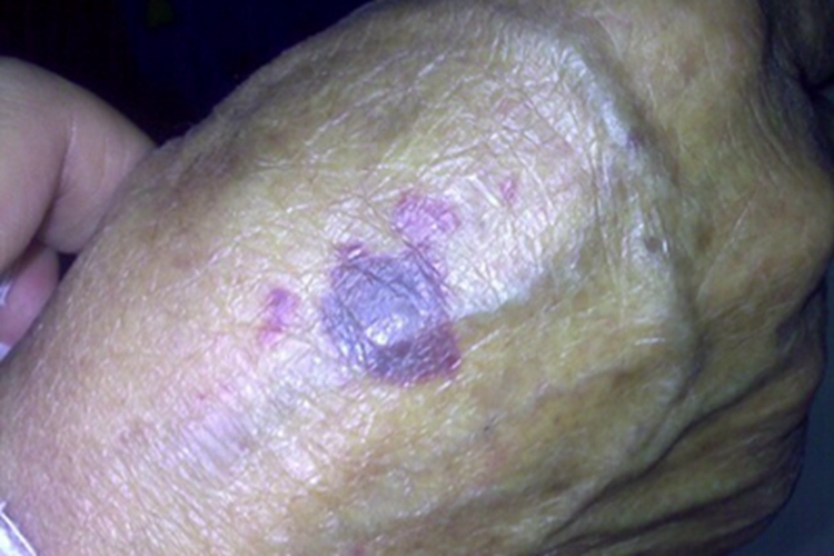 瘀斑手背深紫色斑块图 瘀斑手背深紫色斑块图