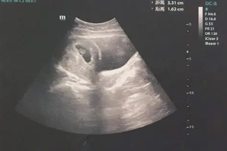 怀孕40天左右胚芽B超图