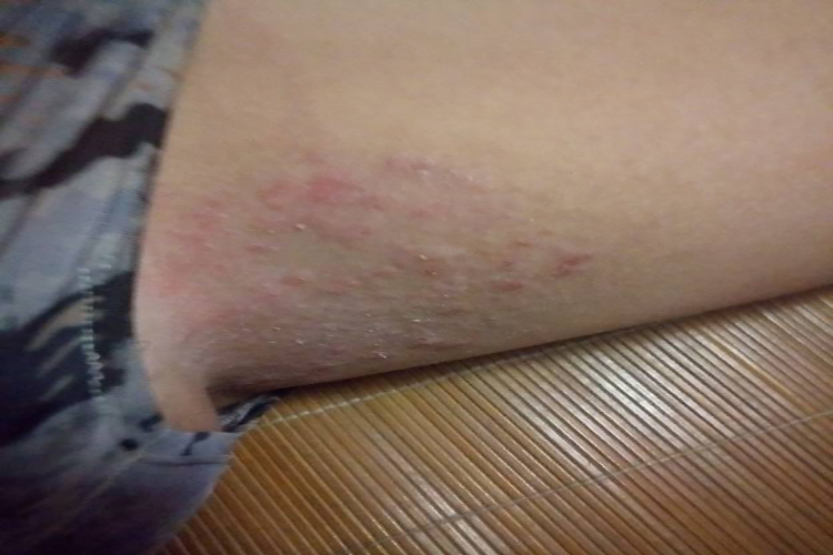 大腿内侧亚急性湿疹图