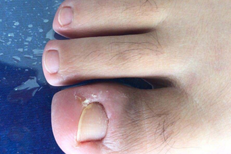 慢性甲沟炎红肿图