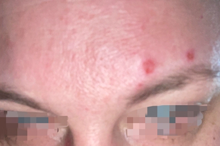 恙螨皮炎前额小红疙瘩图