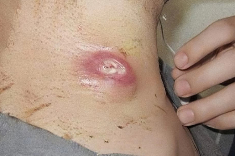 儿童腋下淋巴结结核图 儿童腋下淋巴结结核图