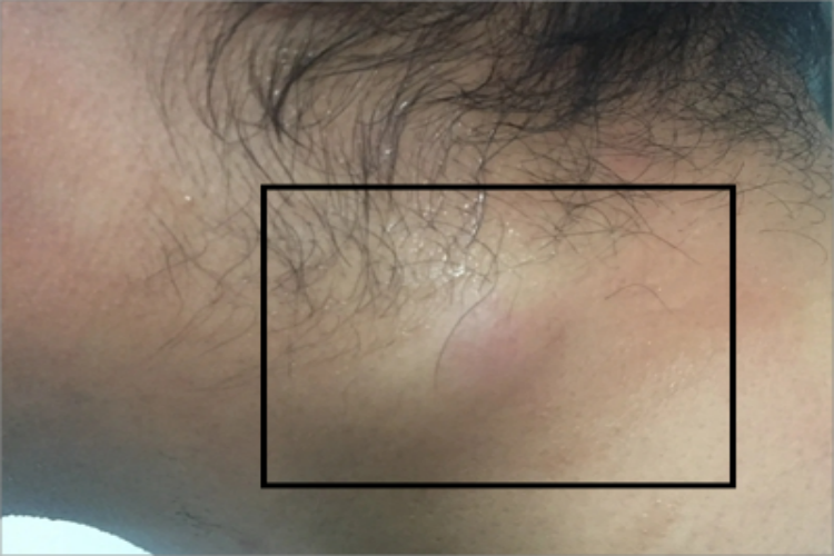 毛母质瘤颈部疙瘩图