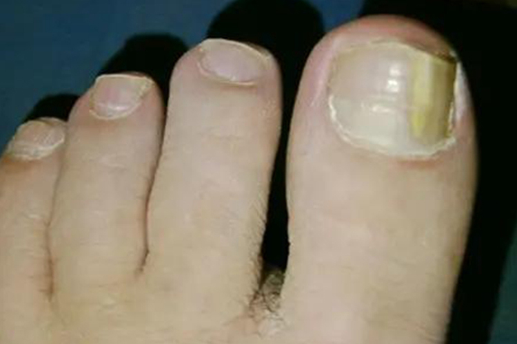远端侧位甲下型甲癣图 远端侧位甲下型甲癣图